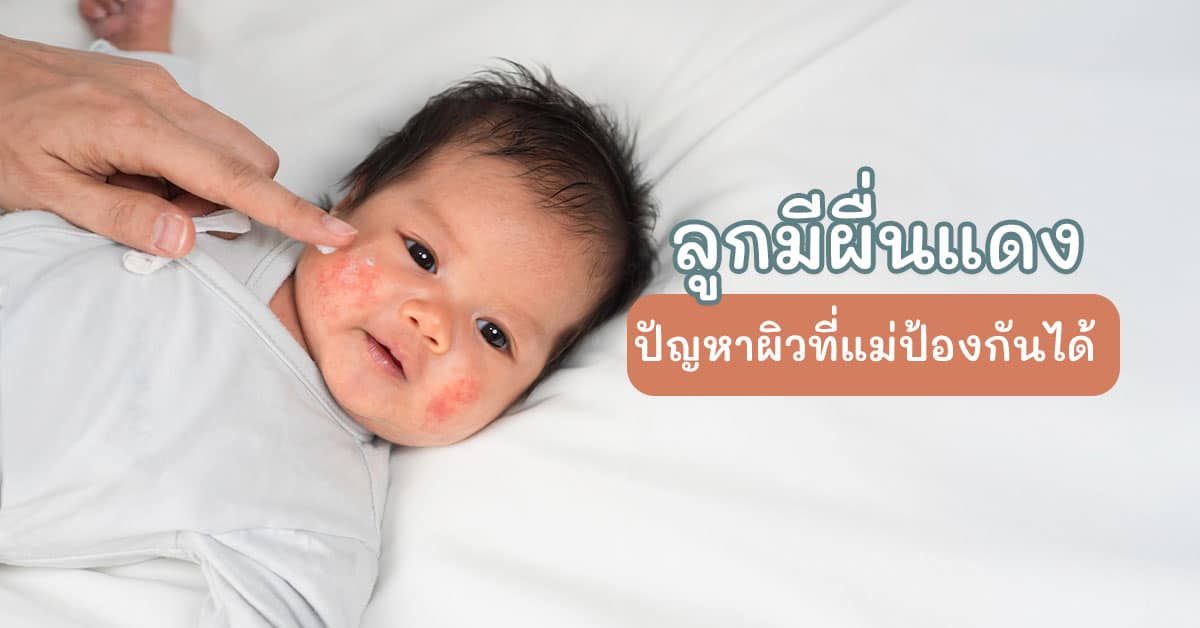 ลูกมีผื่นแดง
