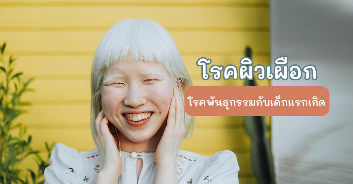 โรคผิวเผือก