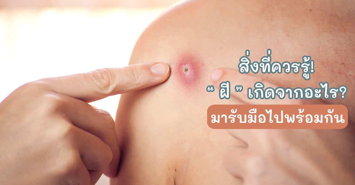 abscess