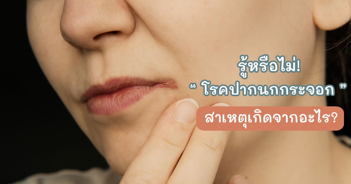 Angular Cheilitis