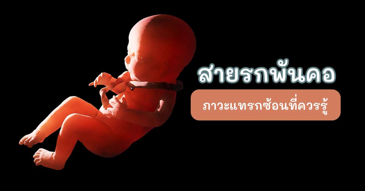สายรกพันคอ