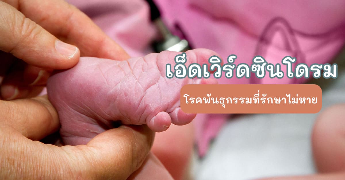 เอ็ดเวิร์ดซินโดรม